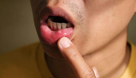 Something You Should Know about Mouth Ulcers